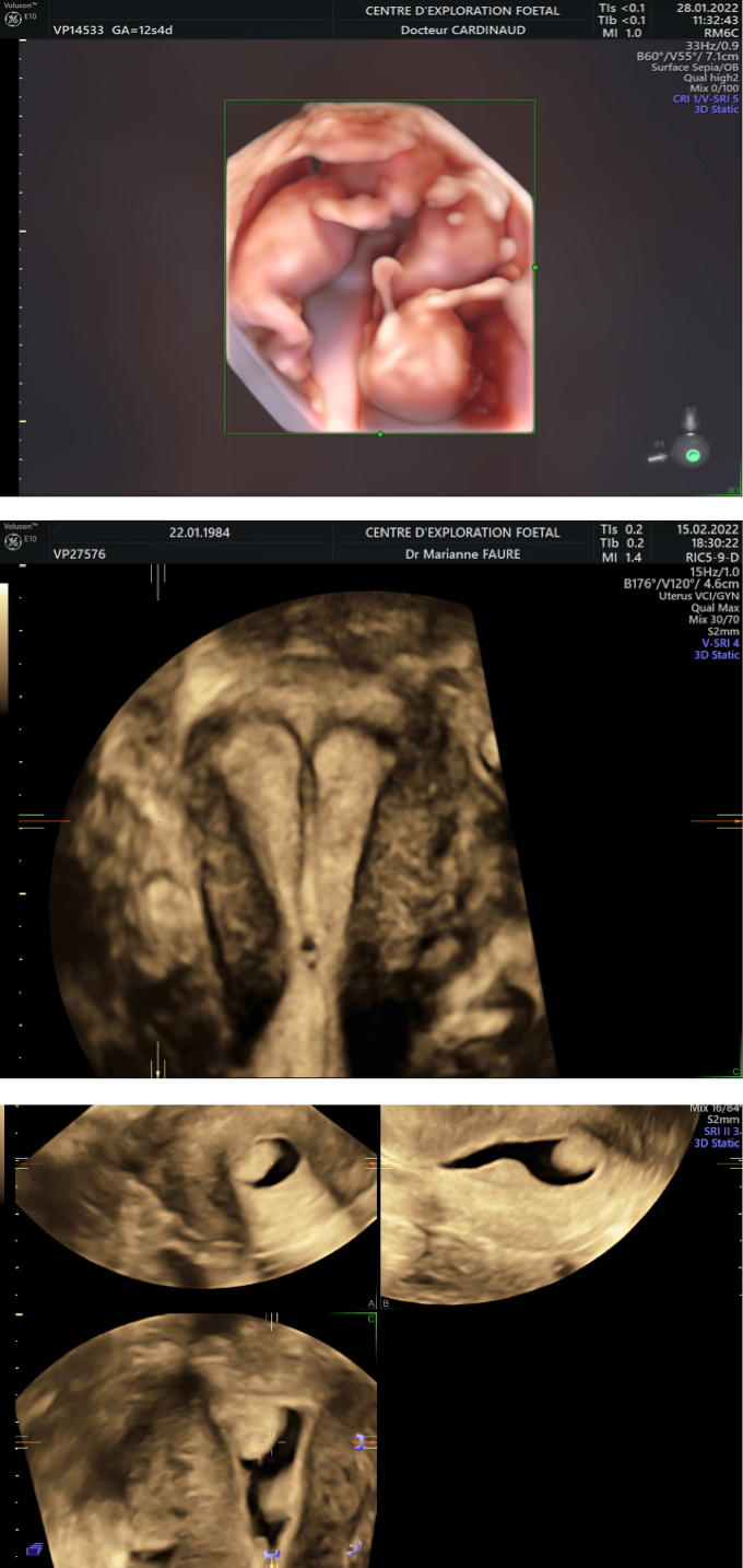 Echographie de grossesse à 22 semaines d'aménorrhée 